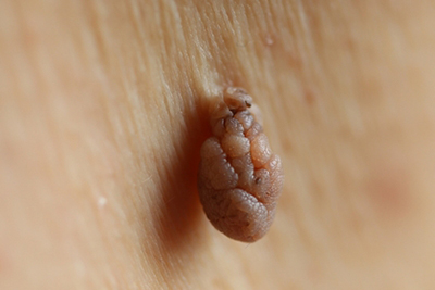 Close-up view of skin tags for dermatology reference