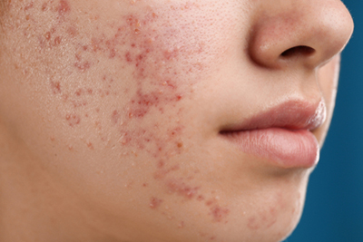 Zoomed-in image of acne breakouts on the cheek of a female patient.