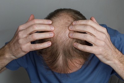 Top view of a man with hair thinning and balding on the crown