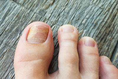 Close view of fungal nail infection on a person’s toe.
