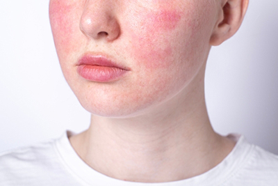 Close-up of a woman’s face with visible redness and inflammation from rosacea.
