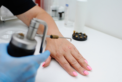Dermatologist performing cryotherapy for wart removal